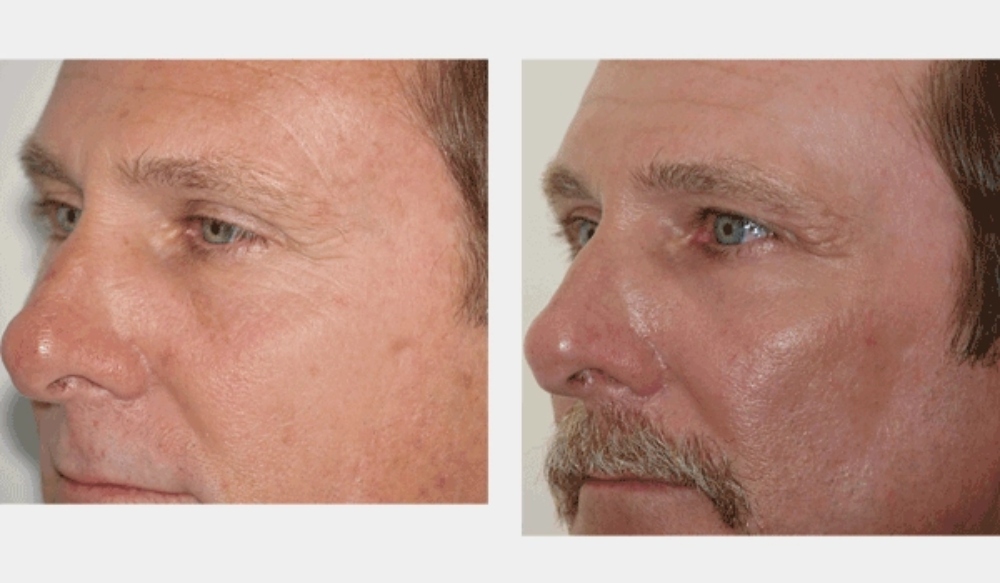 before and after comparison of man's face