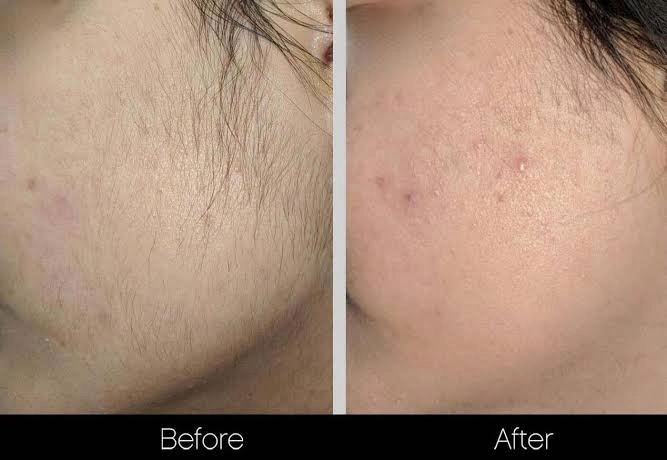 before and after facial comparison