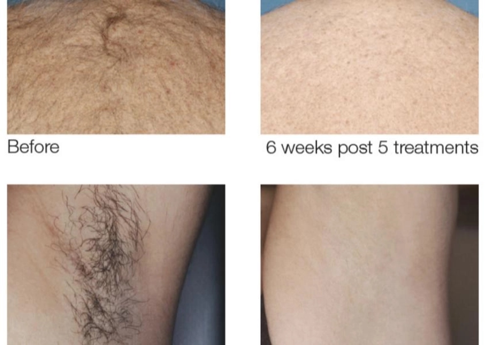 before and after hair removal comparison