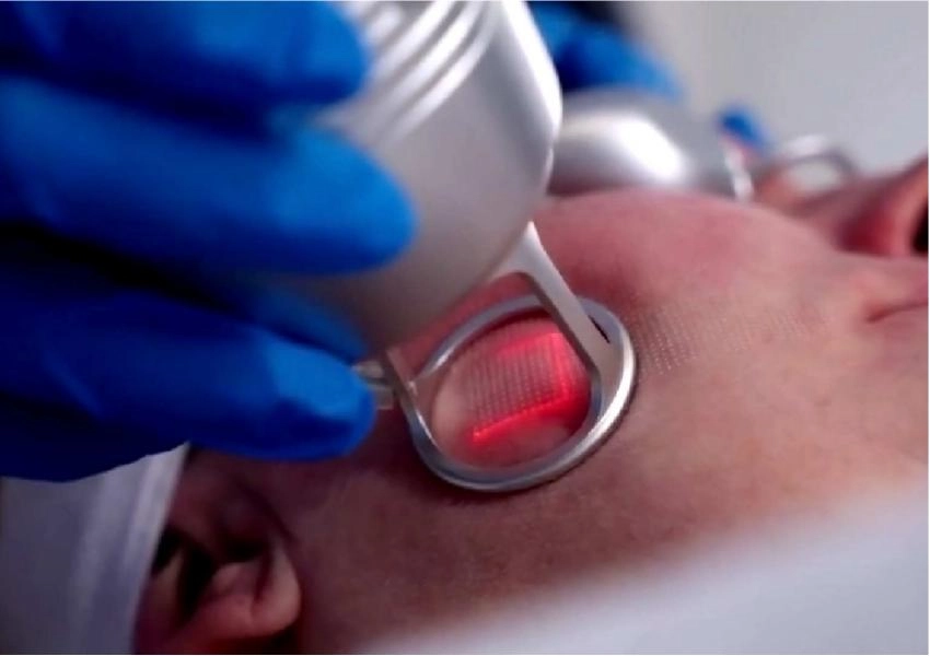 Candela CO₂ RE vs MQLASER DIATERMOLOGIE: Which Format Fits Beauty Businesses and Buyers