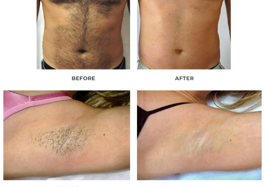 before and after hair removal comparison