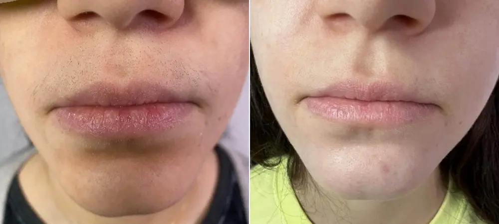 comparison of a woman's lip area