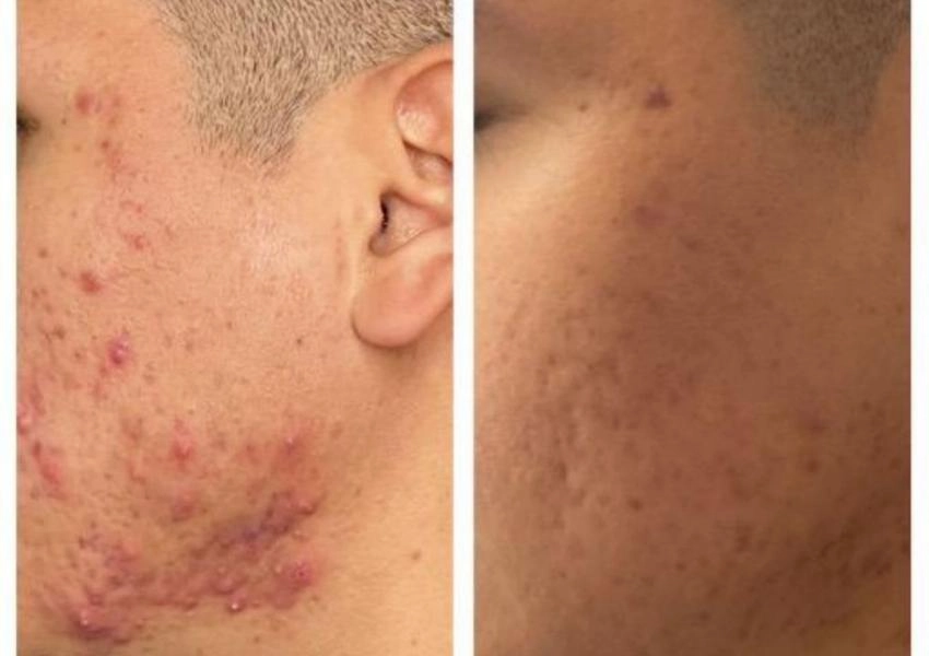 face before and after CO₂ laser treatment