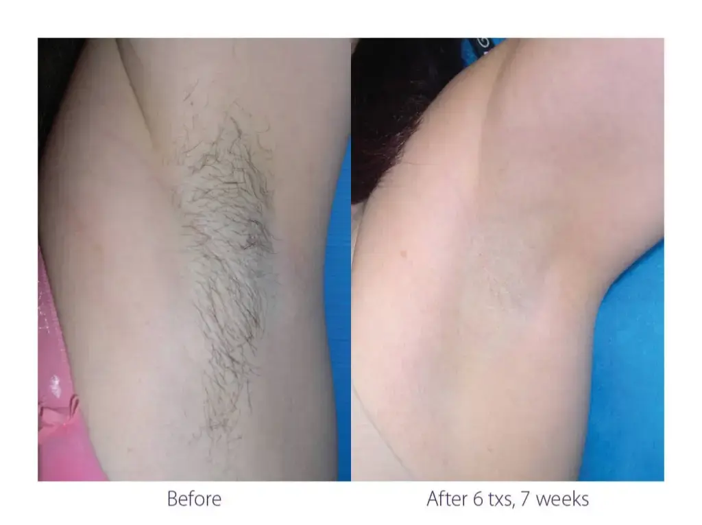 laser hair before after armpit
