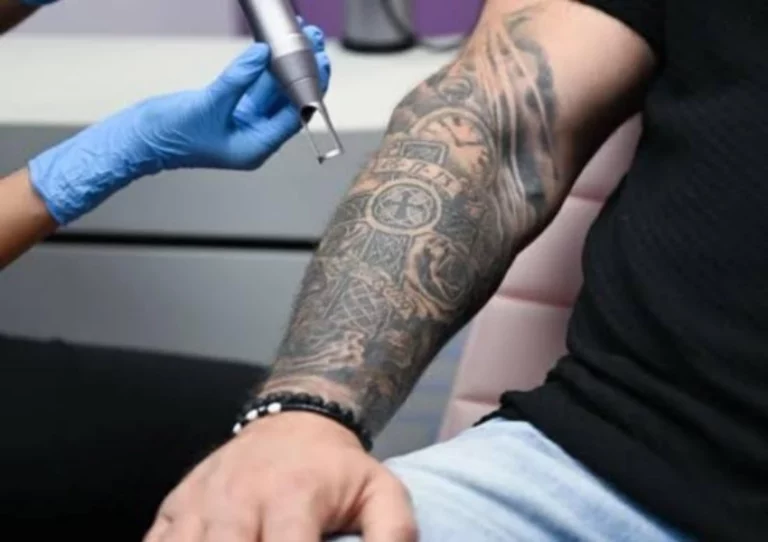Picosecond Laser Machine for Tattoo Removal What Distributors Should Compare
