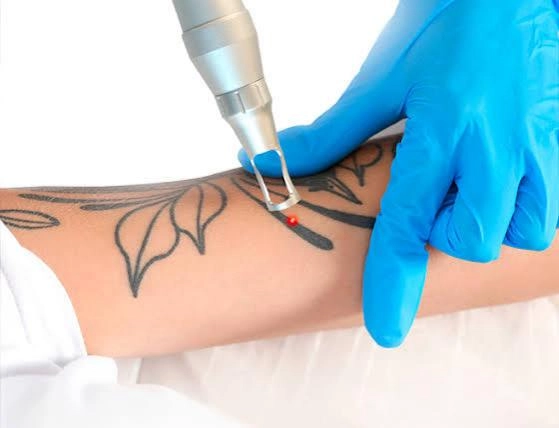arm tattoo removal