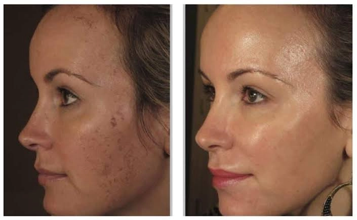 before and after comparison of a woman's face