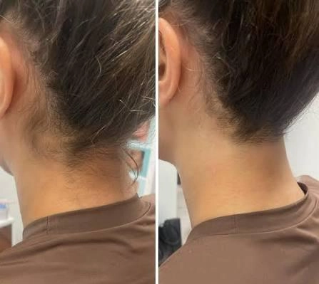 before and after neck hair removal