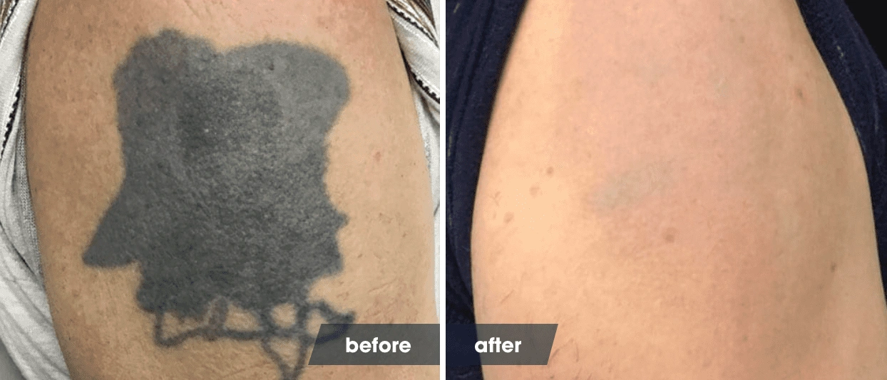 tattoo removal before and after