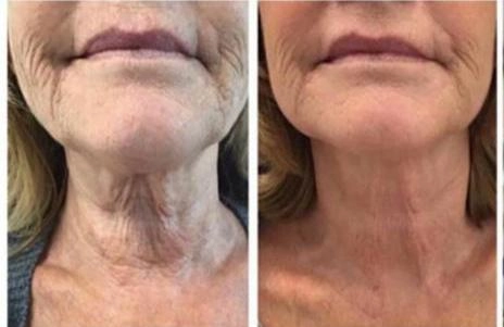 comparison of a woman's neck before and after